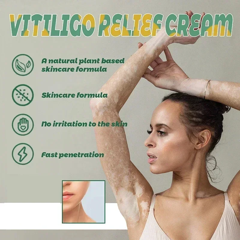 Успокаивающий Крем Vitiligo Repigmentationcream Vitiligo крем для лица Vitiligocream для белых пятен