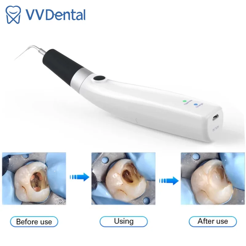 VVDental Sonic Irrigator Tips Endo Activator For Dental Instrument Root Canal Sonic Irrigator Endodontic Dental Tools