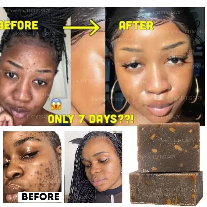 African Black Soap To Remove Melanin Anti-aging Beauty Moisturizing Natural Bath Body Treatment Acne Whitening Skin Care