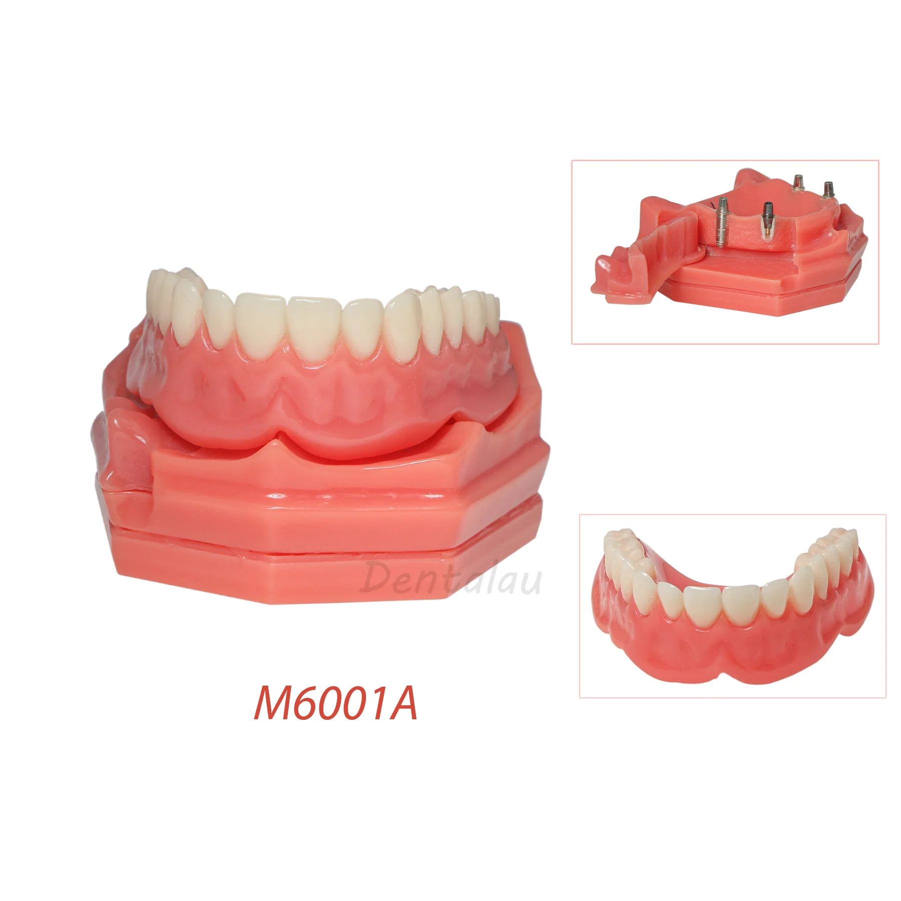 

Dental Implant Model Overdenture Model Demonstration Semi-oral Removable M6001-A