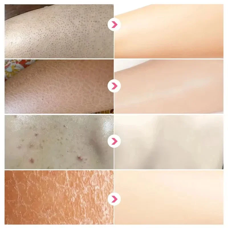 Curing Keratosis Pilaris Chicken Follicle Skin Repair Cream Body Dark Spot Remove Whitening Smooth Moisturize Body Skin Care