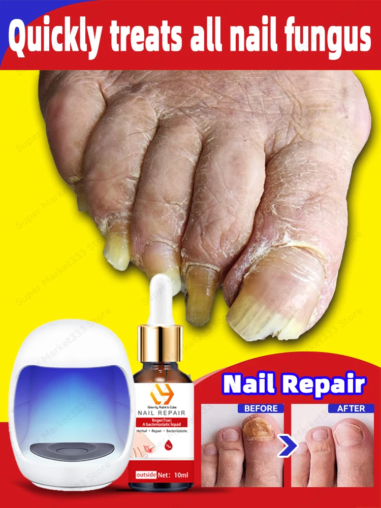 

Laser For Solving Feet Nail