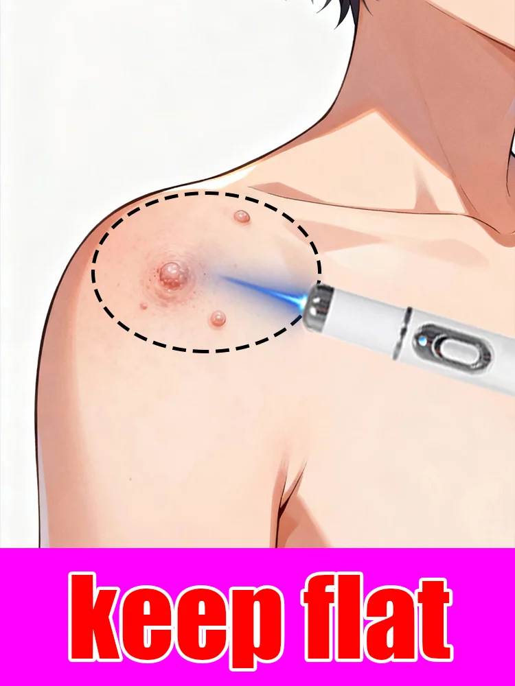 사마귀 치료 도구 블루 라이트 펜은 사용하기 쉽습니다