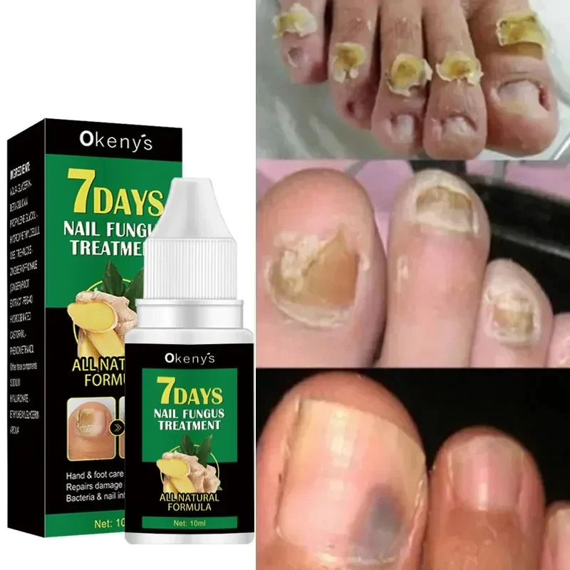 Sérum de traitement des champignons des ongles, bain supplémentaire, huile d'essence, réparation des pieds, crème de soin, anti-infection, élimination des champignons, Parker, N64.