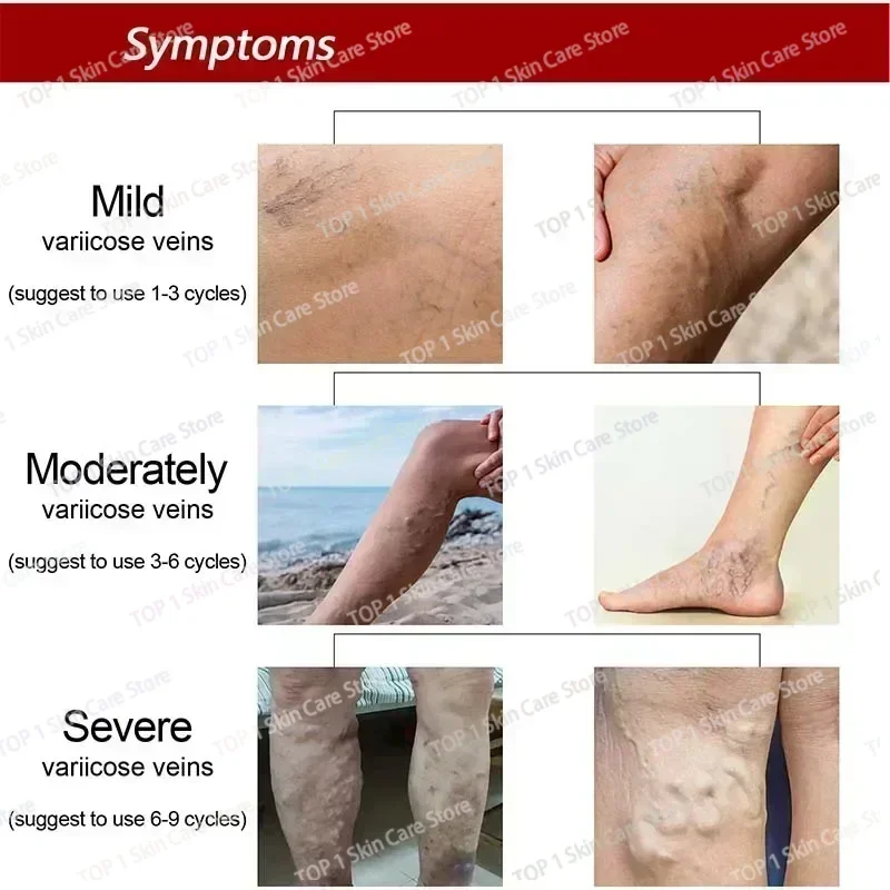 Improvement of moderate varicose veins, relief of pain, and improvement of blood circulation