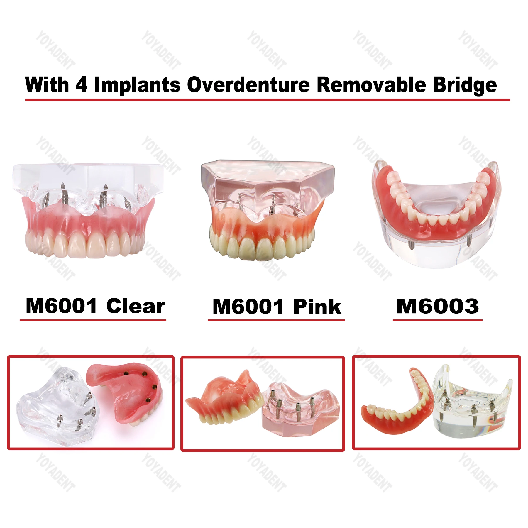 Dental Teeth Model With 4 Implants Overdenture Restoration Bridge For Dentist Implant Treatment Demo Dentistry Accessories