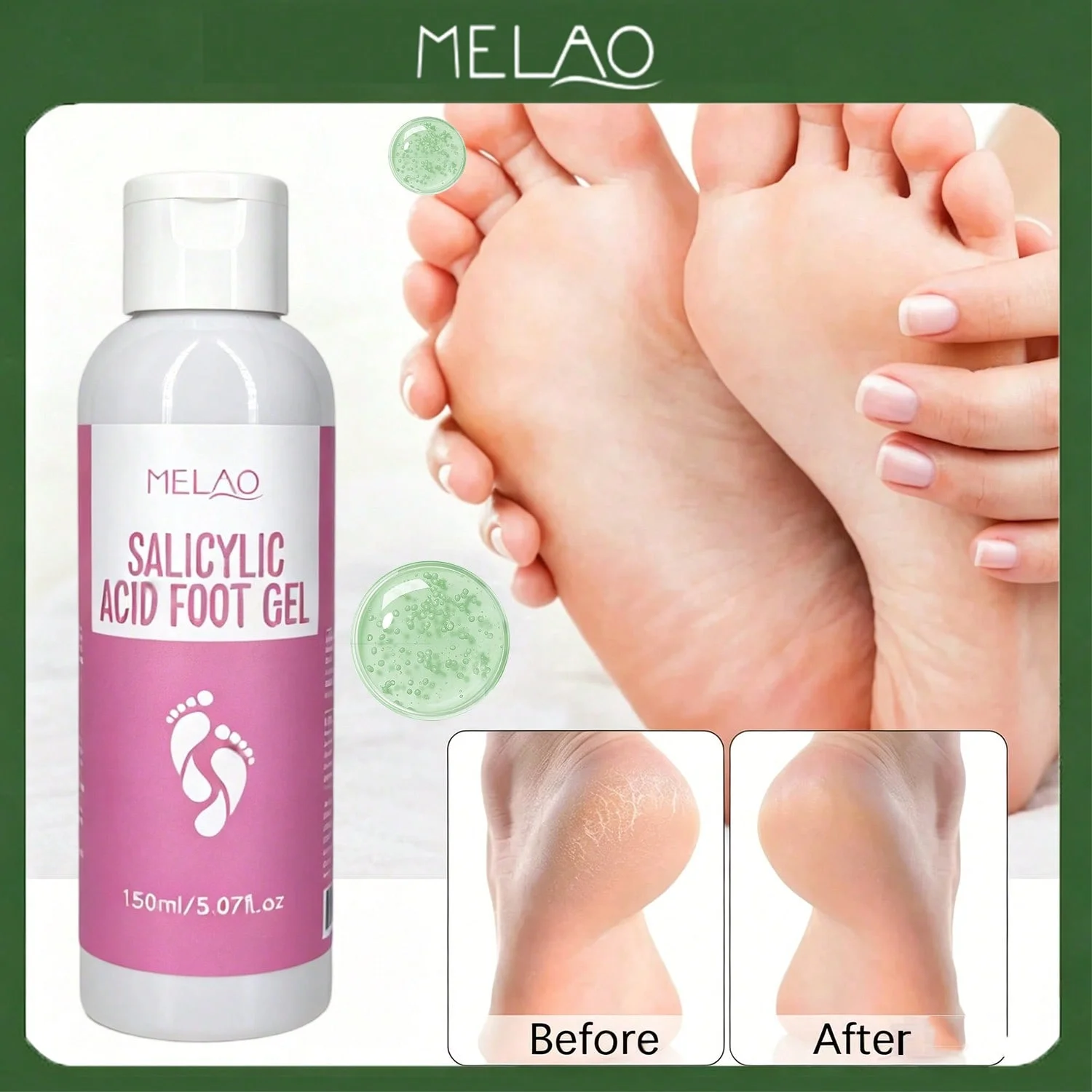 MELAO Salicylic Acid Foot Gel - Dead Skin & Callus Remover, Exfoliating Treatment for Rough Cracked Feet, Softens Heels, 150ml view 2