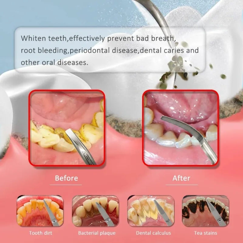 5 Stuk Tandheelkundige Hybride Klimtips Passen Ems Specht Ultrasone Klimtelefoon Dental Odontología