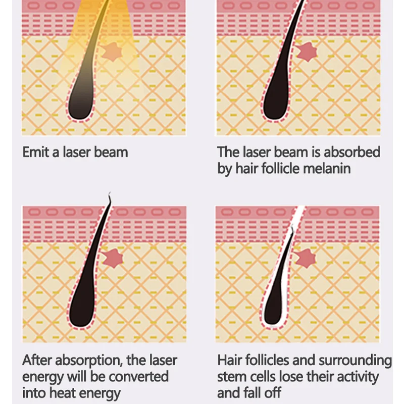 Macchina per la depilazione Laser a diodi 755 808 1064nm Multi lunghezze d'onda testa di raffreddamento epilatore Laser indolore depilazione del corpo del viso