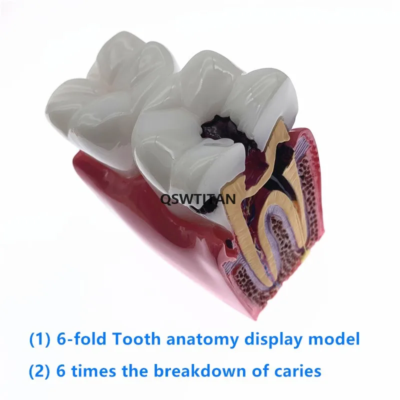 Dental Caries Teeth Comparation Model Dental Study Education Demonstration Teaching Model