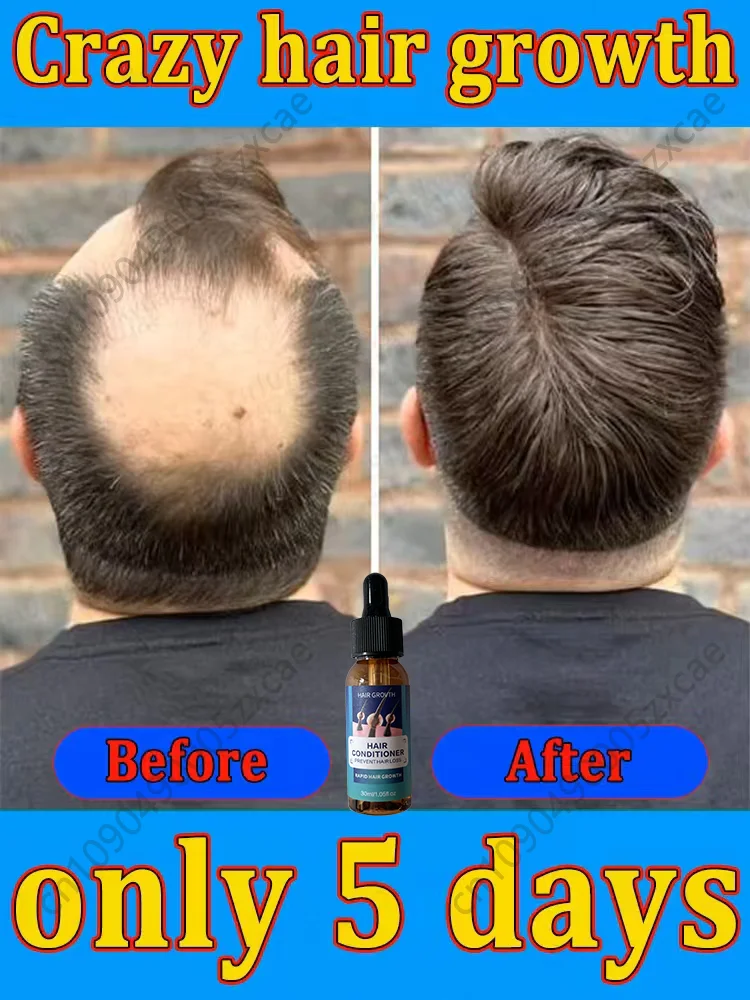 Hot sale, buyers will buy again, hair is getting more and more, say goodbye to baldness, sparse hair starts to become thick