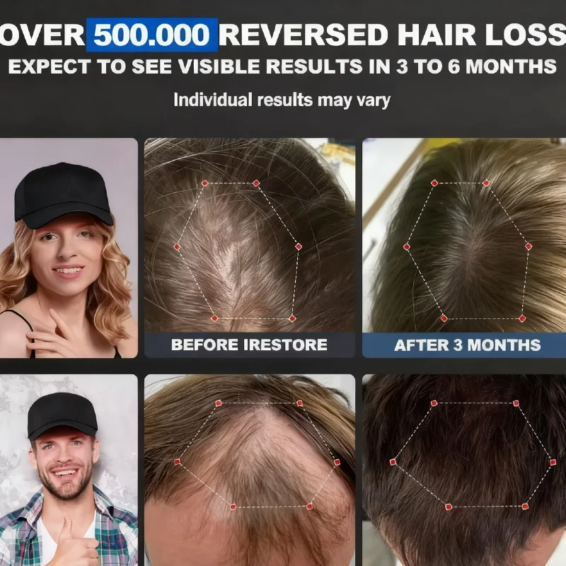 

Red Light Therapy Cap 650nm, Infrared for Seborrheic Alopecia and Areata Hair Growth