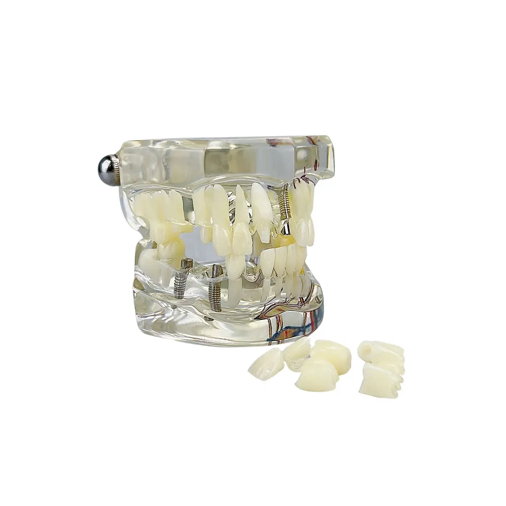 

Dental Models Teeth Neural Repair Resin Models Of Diseased Teeth For Teaching And Research In Medicine And Dental Diseases ﻿