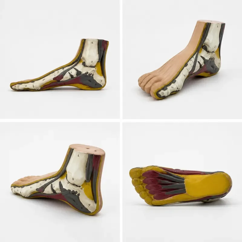 Healthy vs Deformed Foot Model Flat Foot Normal Arch Pes Cavus Pathology Display for Medical Teaching