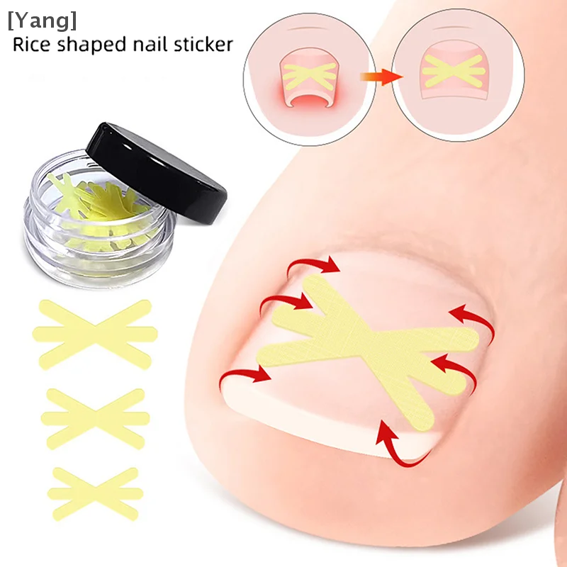 10Pcs Mi Shaped Ingrown Toenail Correction Clip Sticker Pedicure Toe Tools Nail Treatment Elastic Straightening Clip Brace