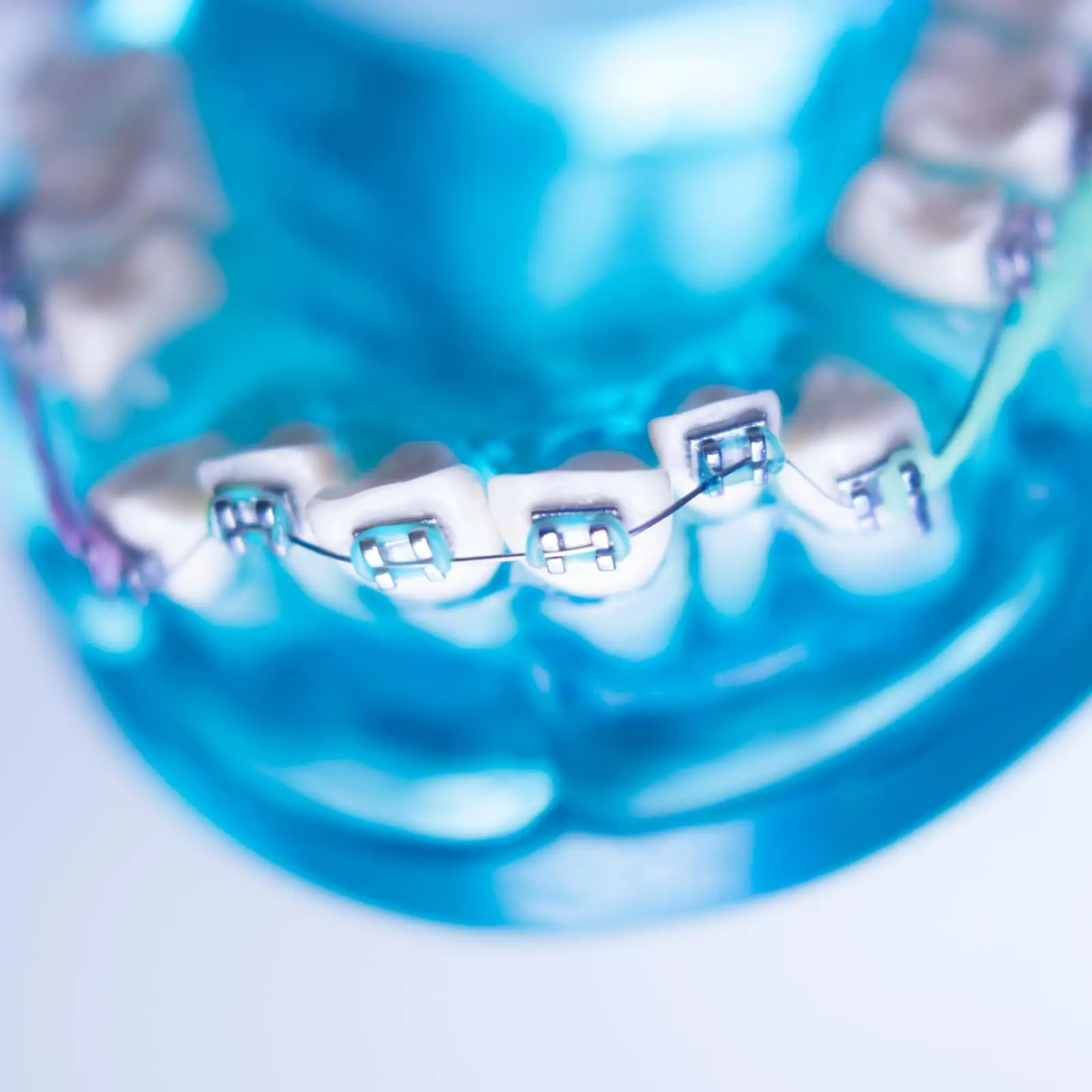 Modische Zahnspangen, bunt, 1 Paar, temporäre Zahndekoration mit Metalldrähten, Metallhalterung, kieferorthopädische Ligaturen, hohe Qualität – Detail 7