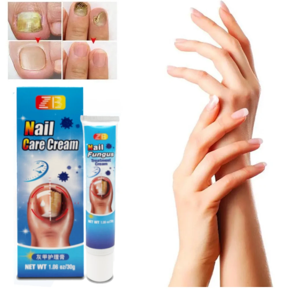 30g Nail Fungus Ointment Fungal Infection Nails Cream Feet Anti Removal Onychomycosis Paronychia Toe Repair Essence Herbal Cream