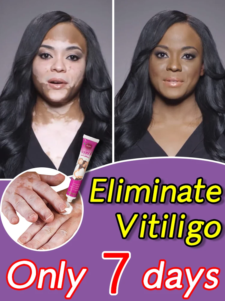 

Vitiligo Cream Melanin Grown Skin Care