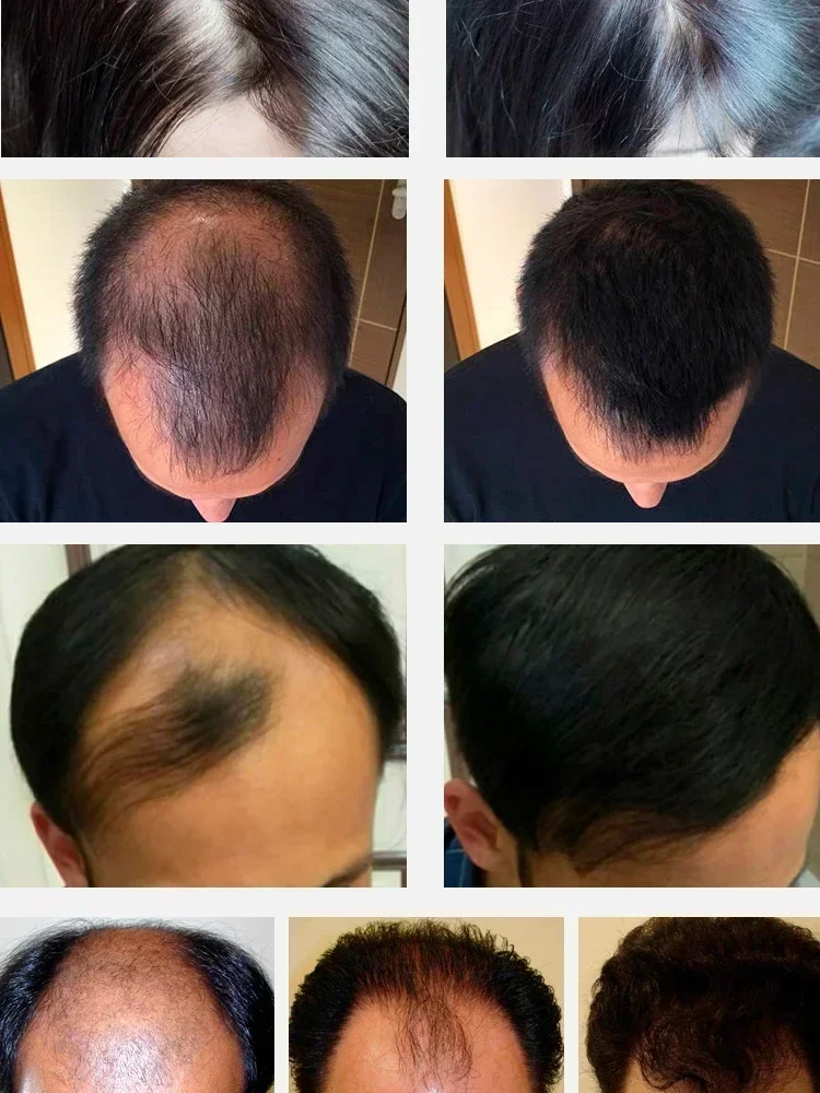 Anti Haarverlies Serum Snelle Haargroei Serum Voedende En Zorg Voor Mannen En Vrouwen Haar