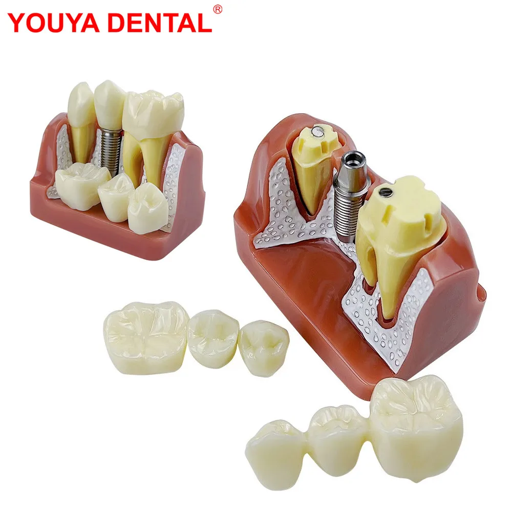 

4 Times Dental Implant Teeth Model Dentistry Removable Analysis Crown Bridge Model For Studying Training Teaching Demonstration