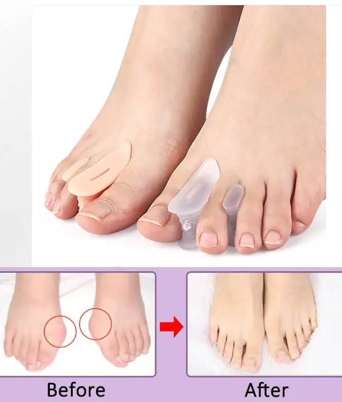 1/5Pairs Forefoot Pad Hallux Valgus Toe Separator Clamp Forefoot Pad With Holes Thickened Sole Toe Separator