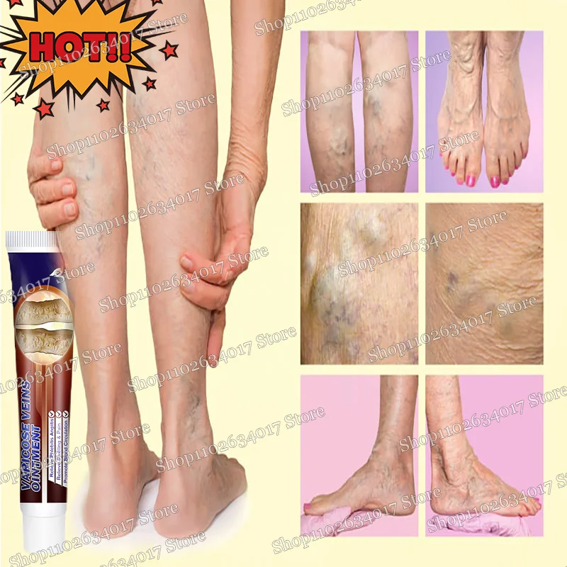 Leg frost varicose veins, heavy legs, swelling, best prices and discounts