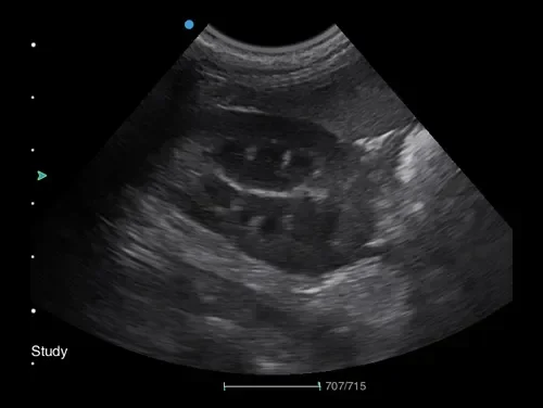 SYA-Apogee 2300 Echo Hospital 4d echocardiography