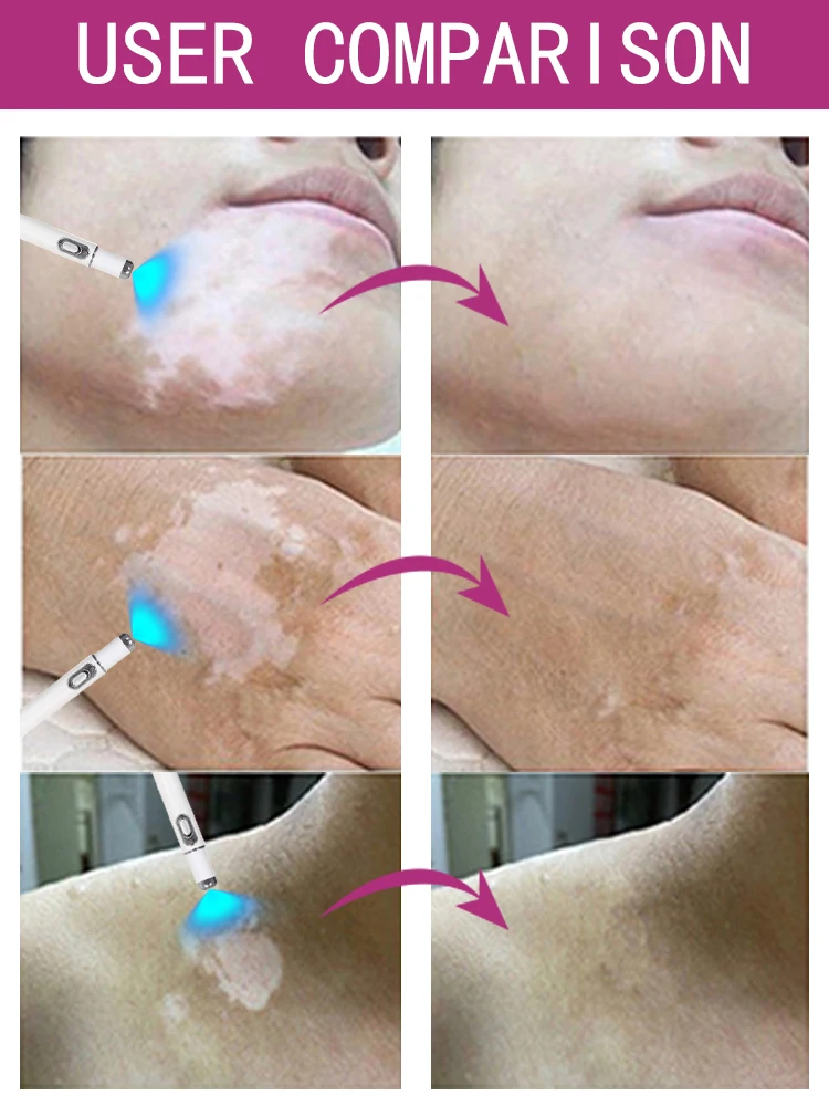 Hot Selling Verbeteren Vitiligo Laser