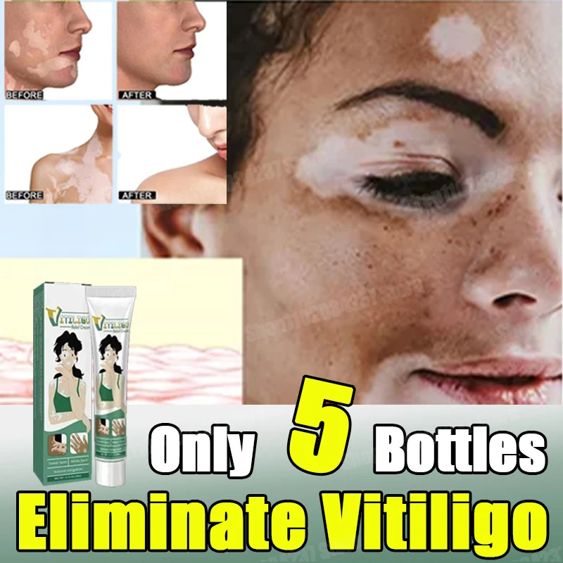 Vitiligo Safe Repair Brightening Lasting Increase Confidence Improve Skin Appearance Natural Ingredients