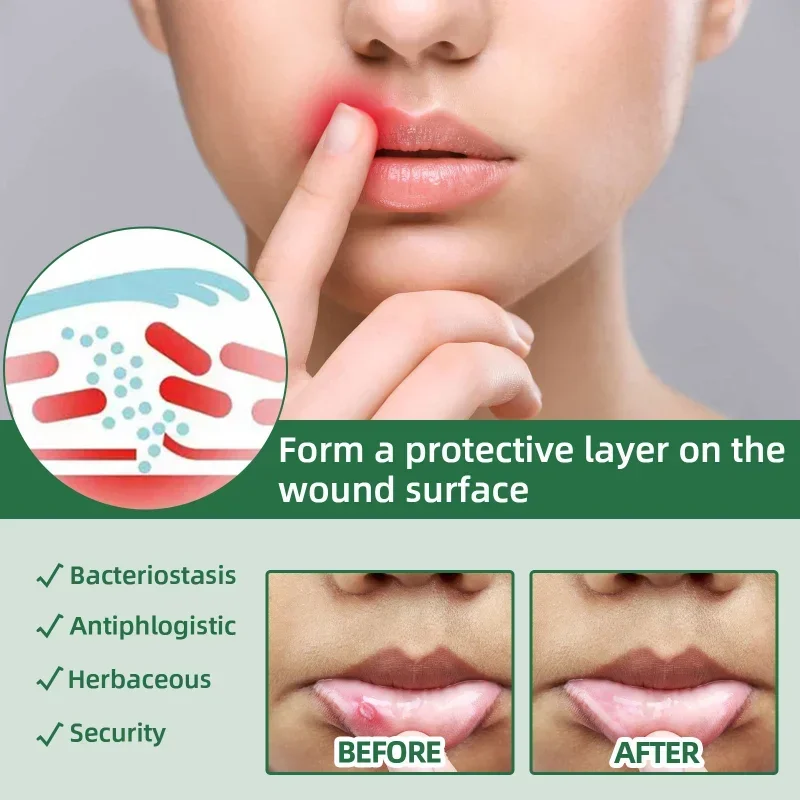 Mouth ulcer spray Treatment swollen gums oral Canker Sores Pain Relief fresh breath Antibacteria Halitosis mouth Clean care