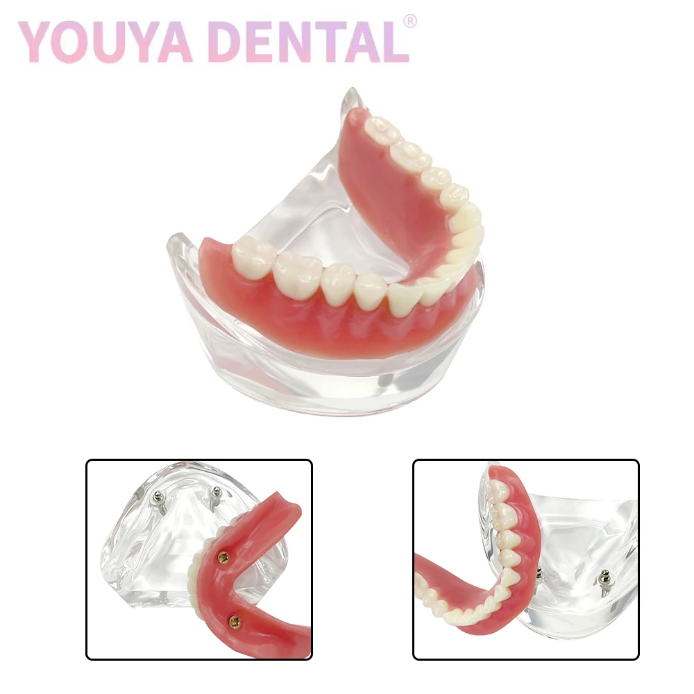 

Dental Typodont Implant Restoration Model M6002 Overdenture Mandibular Band 2 Implant Nail Models For Dentist Teaching Research