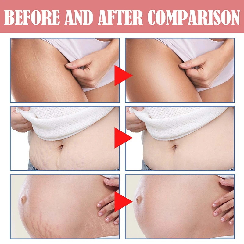 Stretch Marks Remover น้ํามันหอมระเหยการตั้งครรภ์คลอดบุตรใหม่เก่า Stretch Mark Removal Serum เพิ่มความยืดหยุ่นของผิว 20ml