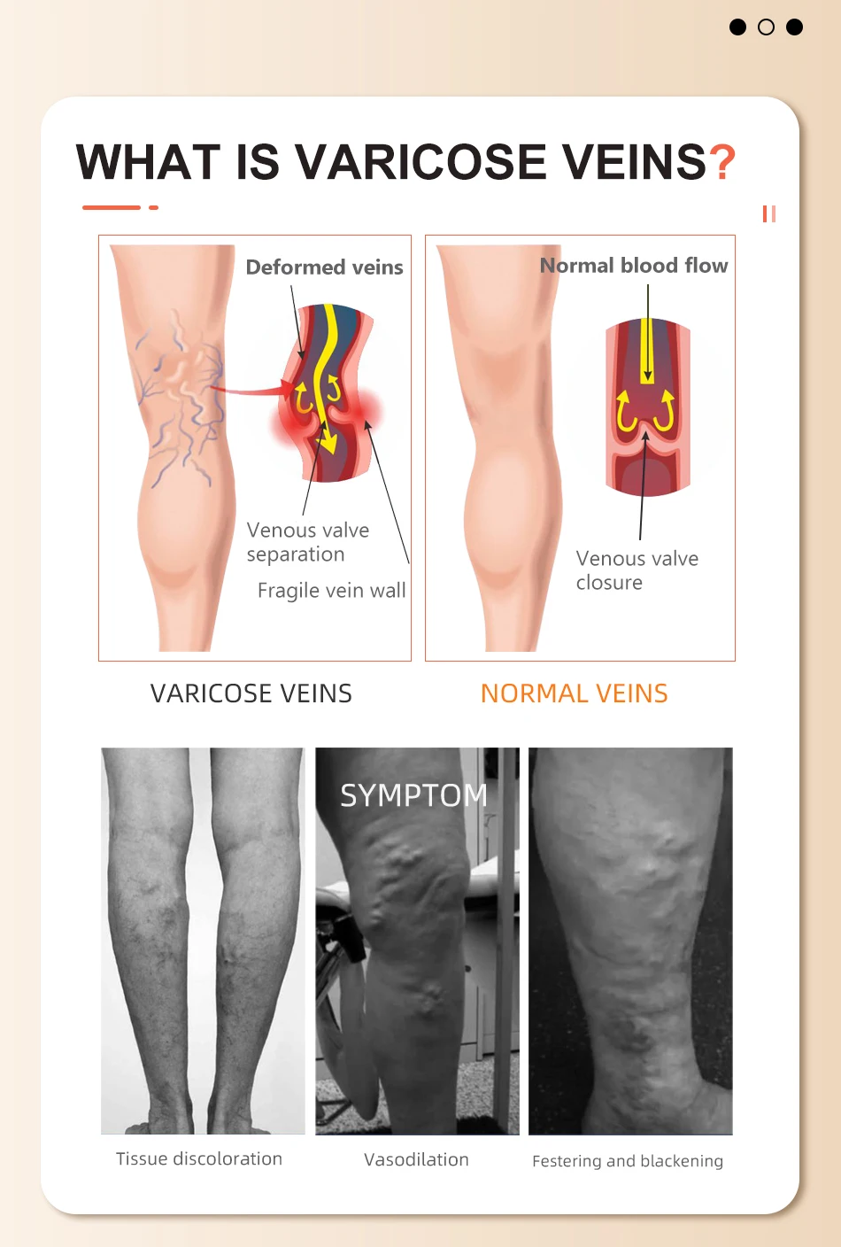 Leg beauty 15-21mmhg kniehohe Kompression strümpfe medizinische Waden socken mit offenen Zehen Krampfadern behandeln die Formung des abgestuften Drucks – Detail 6
