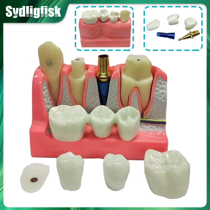 4 Times Dental Implant Teeth Model Analysis Crown Bridge Demonstration Removable Model Dentist Teaching Study Training  Model