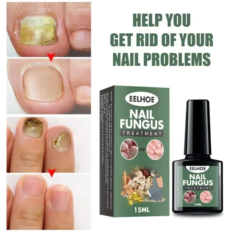 7 dias tratamento de fungos nas unhas essência óleo pé dedo do pé remoção de fungos nas unhas soro reparação unha onicomicosi gel anti infecção cuidados