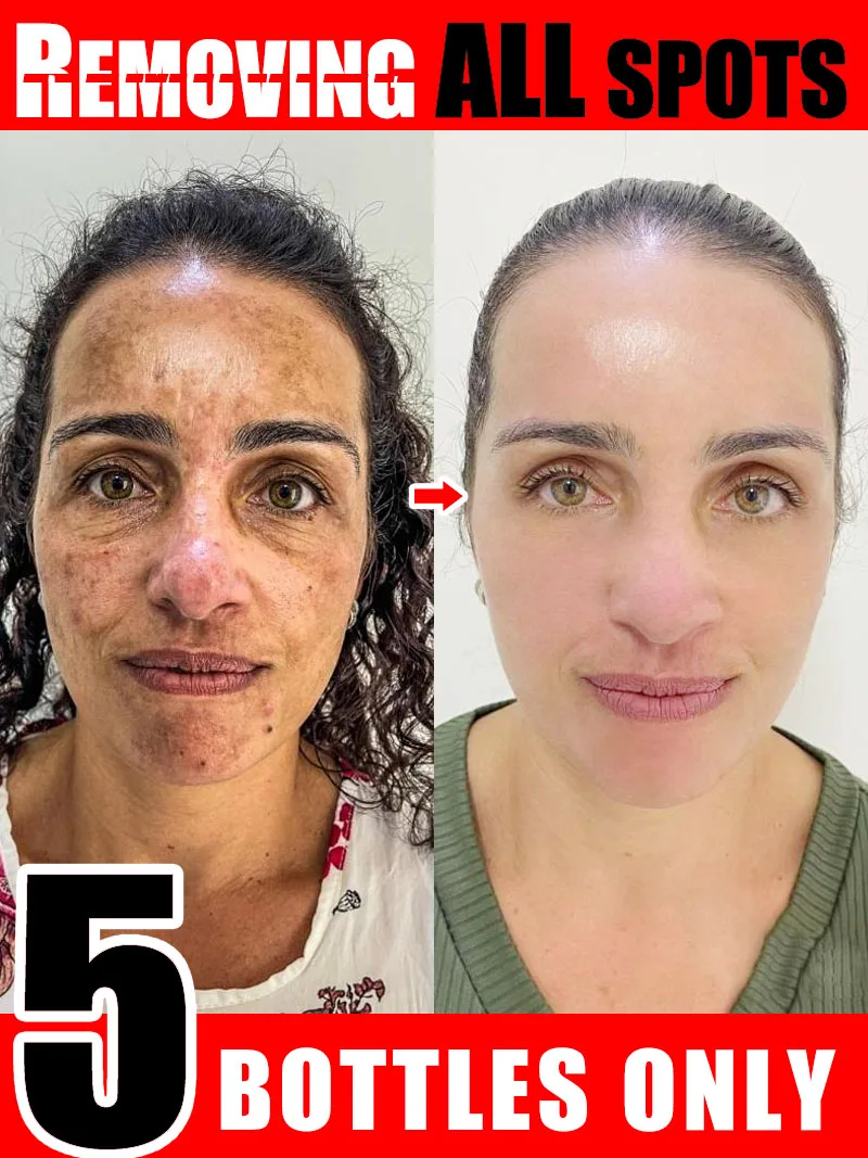 

Осветляющее средство для лица от веснушек, мелазмы и темных пятен