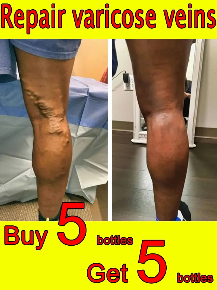 Gel to relieve varicose veins, relieve lumps in legs