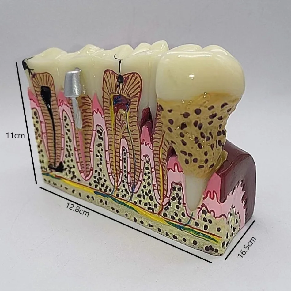 Dental 6x Oral Teaching Anatomy Model of Decayed Teeth, Dental Nerve Model with Decayed Teeth, Doctor-patient Communication