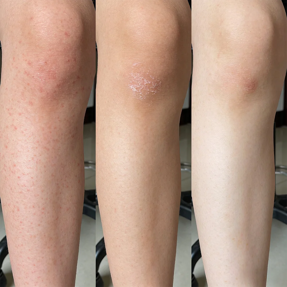 chelnokova glycolic acid peel 50% cleaning tools 70% 60% 50% 40% 30% 20% peel solution Combine the top formats with benefits