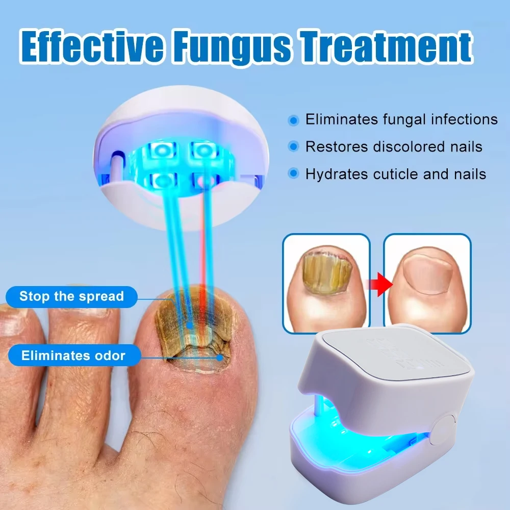 Nail Fungus Laser Treatment Effectively Remove Toenail Repair Laser for Nail Fungal Decvice Onychomycosis Therapy Treat