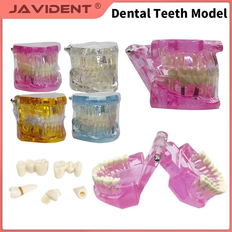 Dental Teeth Model Standard Implant Disease Dentist Studying Demo Dental Typodont Model With Removable Teeth Restoration Bridge