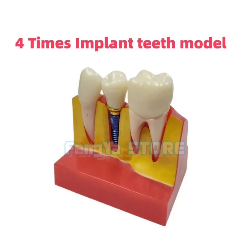

﻿ Съемная модель зубов Typodon 4-кратного увеличения для анализа имплантатов, демонстрации коронок и мостов, обучения в стоматологии и демонстрации зубных конструкций