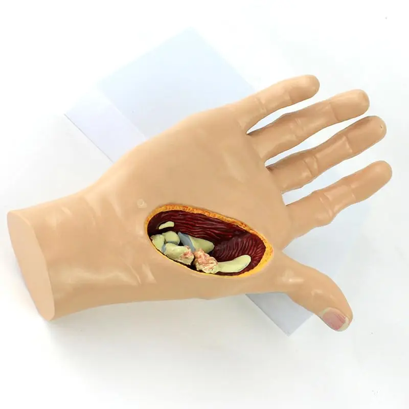 

Anatomical hand model for rheumatoid arthritis teaching and patient demonstration