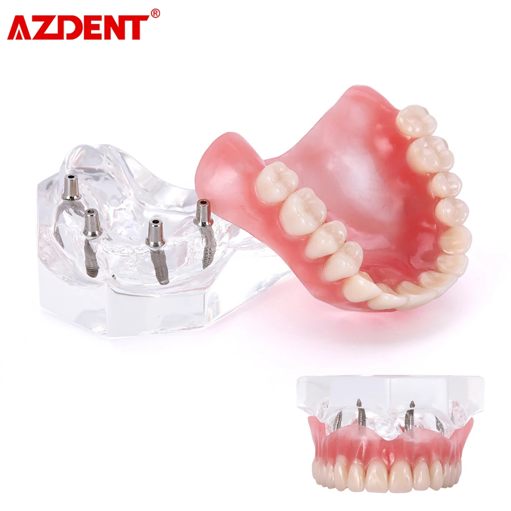 AZDENT Dental Teeth Model Demo Overdenture Restoration With Implants upper/Lower Dentist Student Learning Model