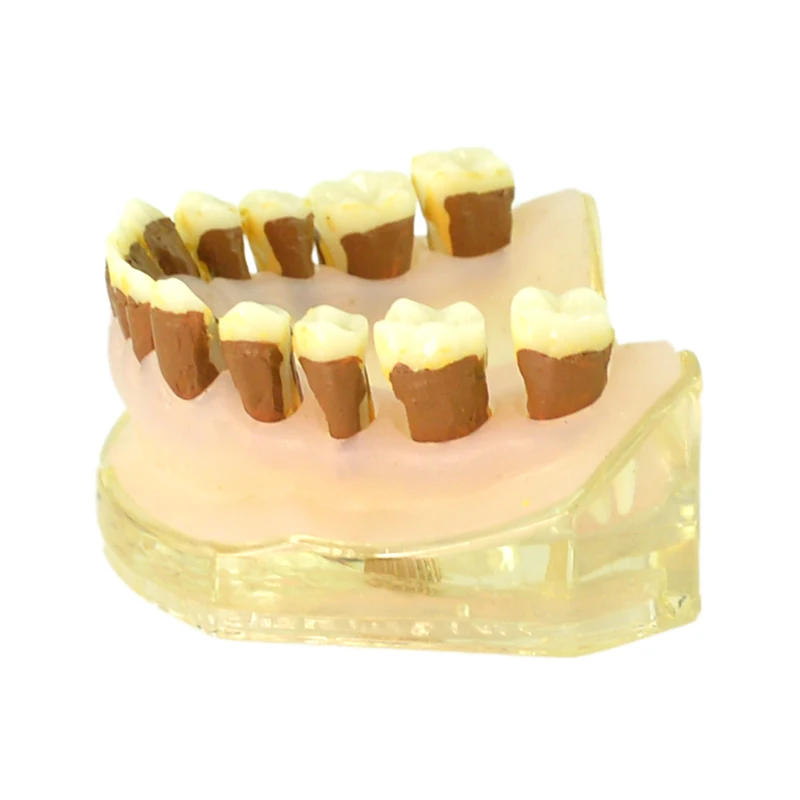 

Dental Periodontal Disease Teeth Model Teach Study Model Demonstration Model of Periodontitis