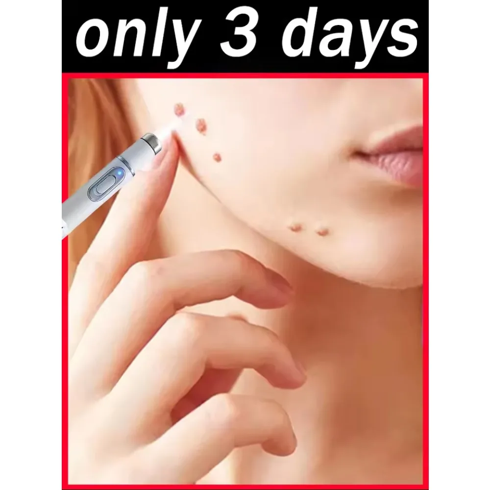 حار yMoleRemoval القلم ثؤلول أداة إزالة البلازما الليزر الجمال العناية بالبشرة الذرة النمش العلامة نيفوس العمر الداكن الاجتياح بقعة الوشم الكهربائية