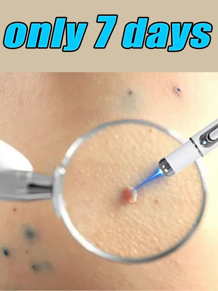 The popular solves your skin problems.quickly removes skin growths, free shipping.