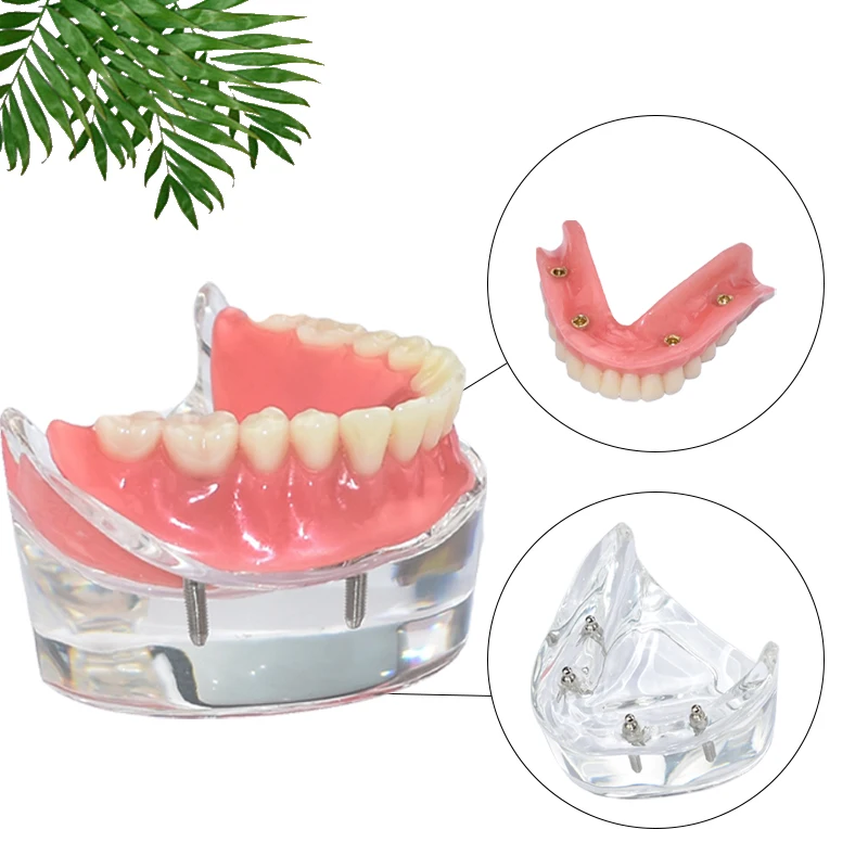 Dental Overdenture Teeth Model Superior Upper/lower Jaw Demo Model with Removable Bridge 4 Implants Restoration Teaching Study