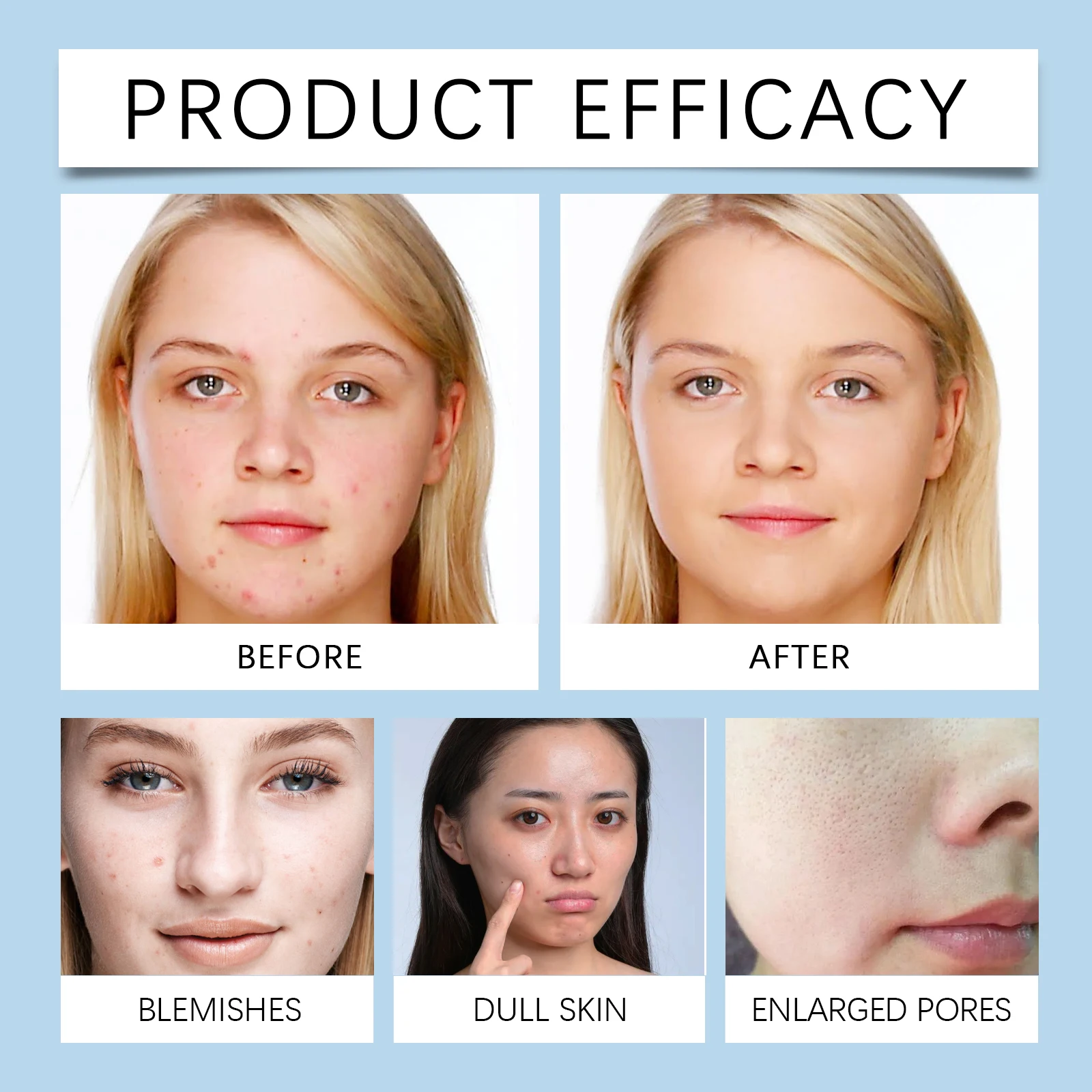 Limpiador de limpieza de ácido salicílico para poros delicados Control de acné Control de aceite refrescante limpiador hidratante profundo