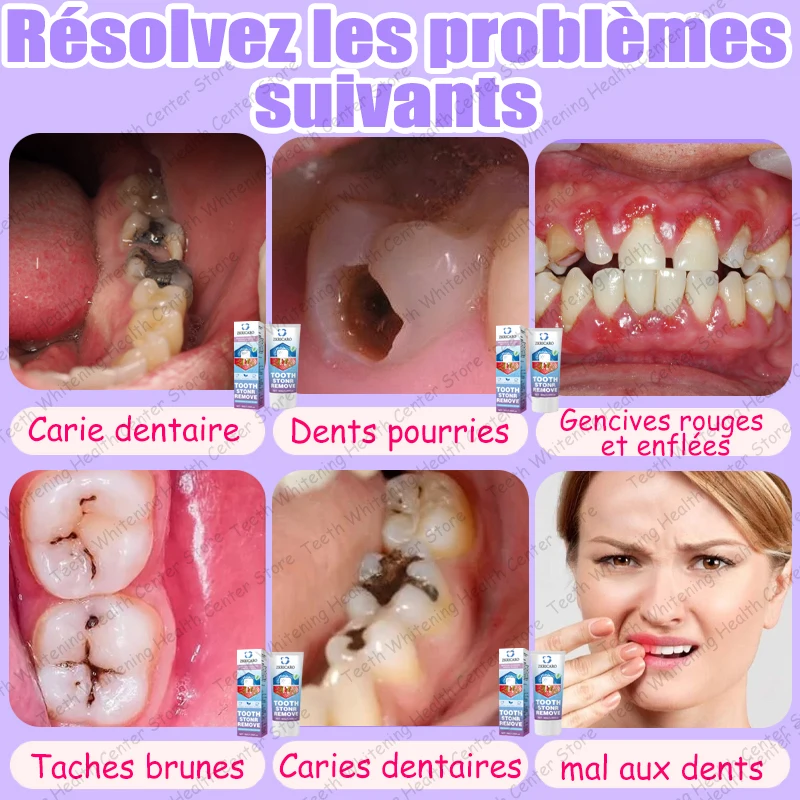 Vendita calda, necessità di molte persone, ripara la carie dei denti e mantiene i denti sani 2026